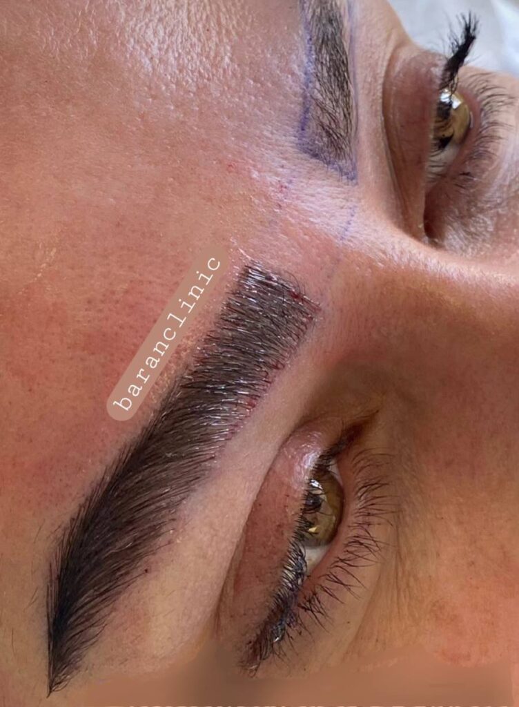 مزایای کاشت مو و ابرو کلینیک باران