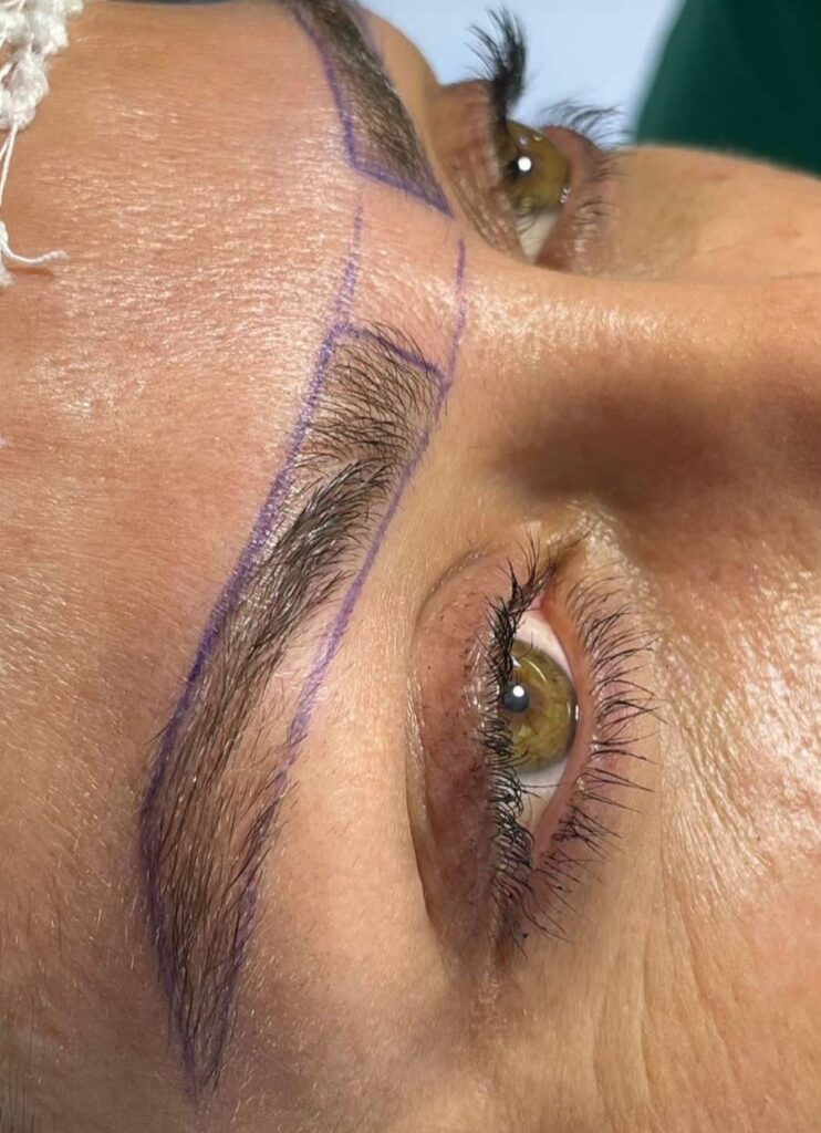 خدمات کاشت ابرو در کلینیک تخصصی پوست و مو در تهران