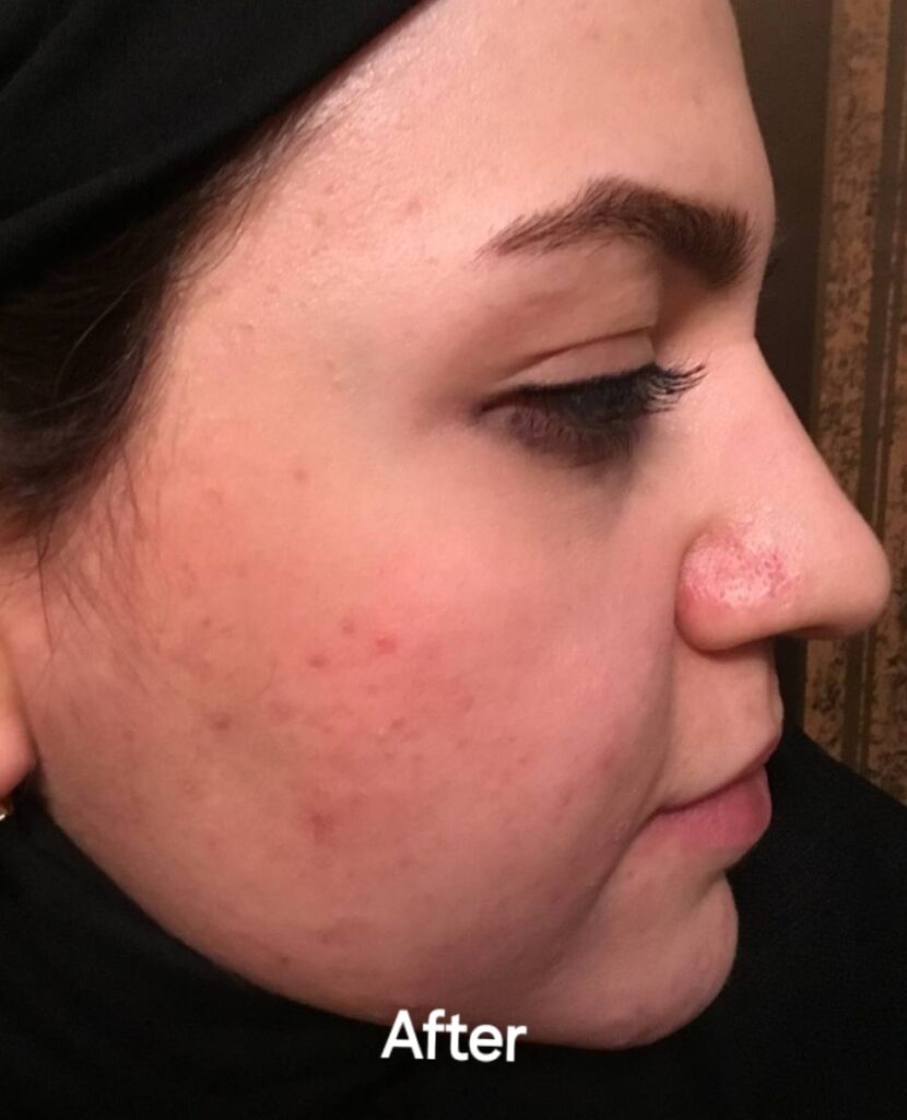 درمان جوش و اسکار با لیزر سی او تو فرکشنال در کلینیک باران