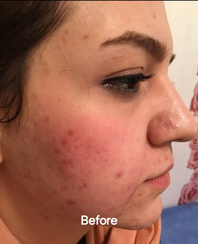 درمان جوش و اسکار با لیزرco2 fractional در کلینیک باران