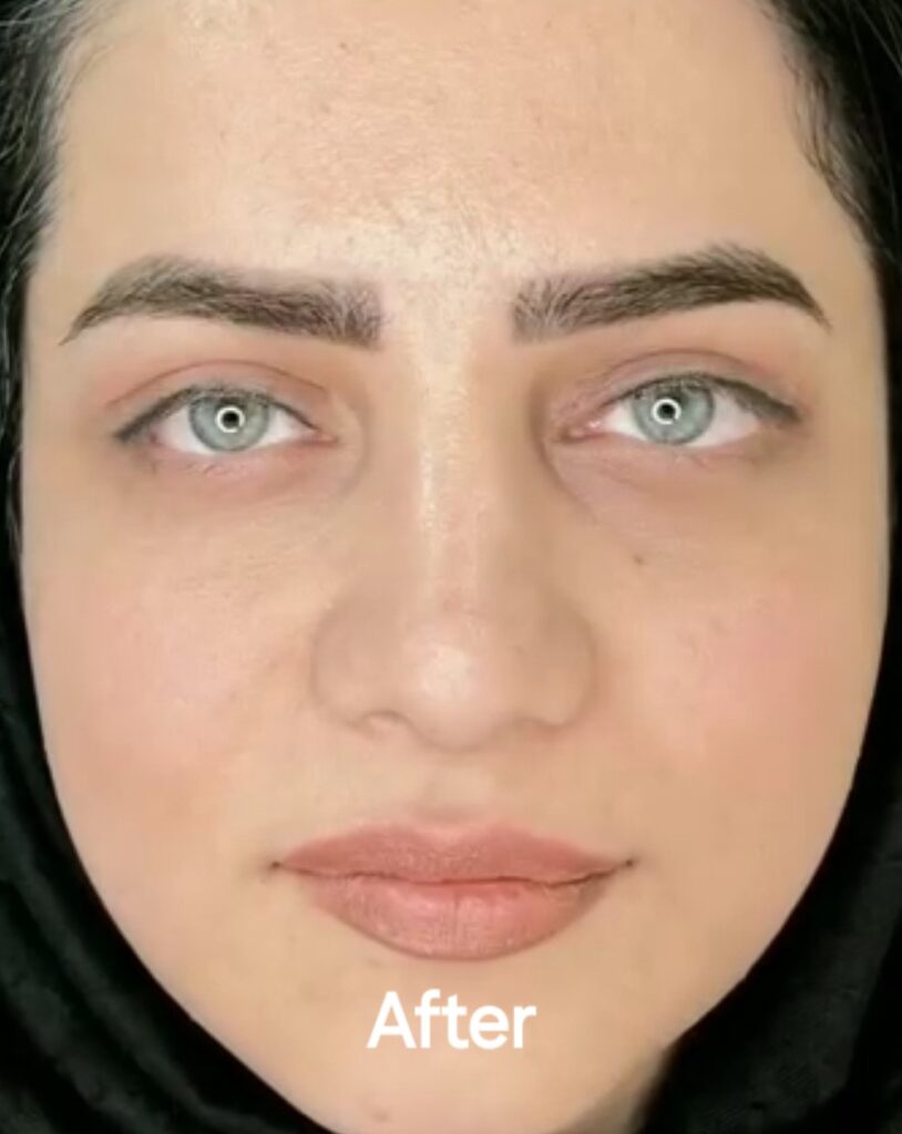 بلفاروپلاستی پلک در کلینیک زیبایی