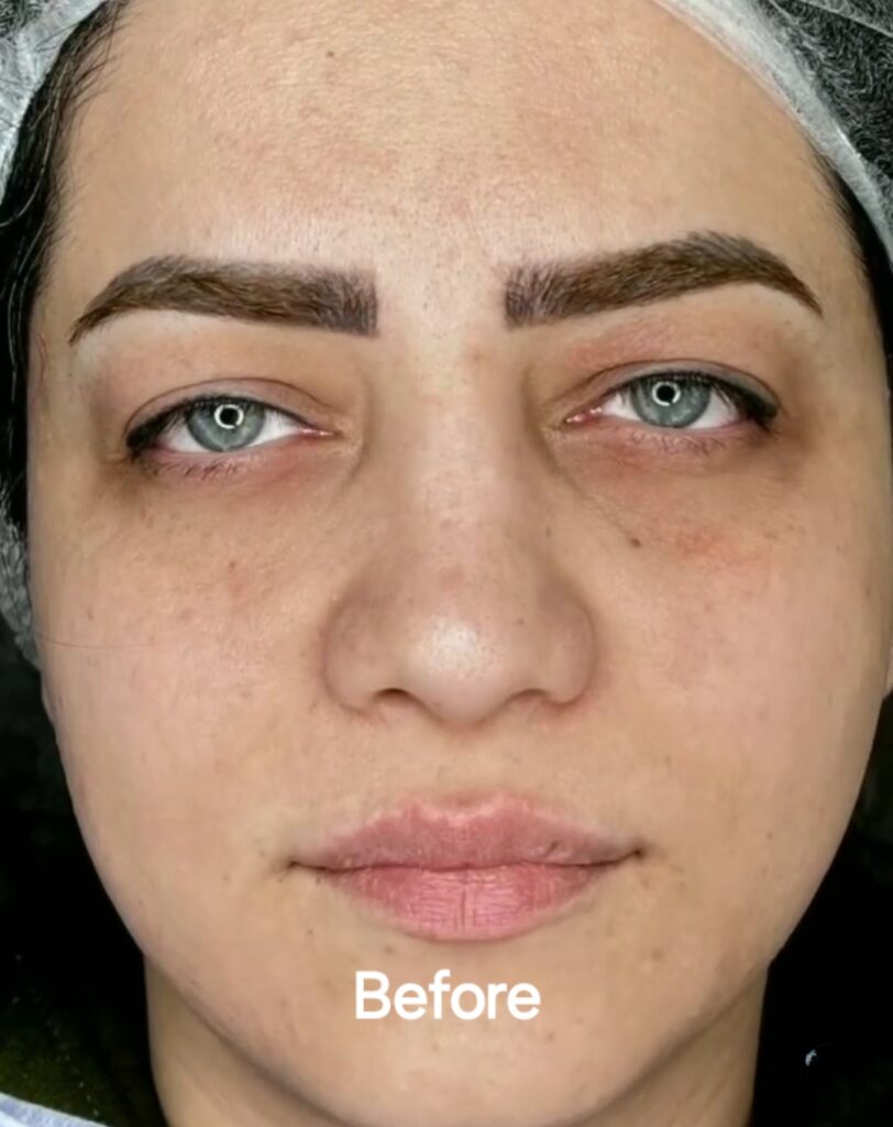 بلفاروپلاستی پلک در کلینیک زیبایی