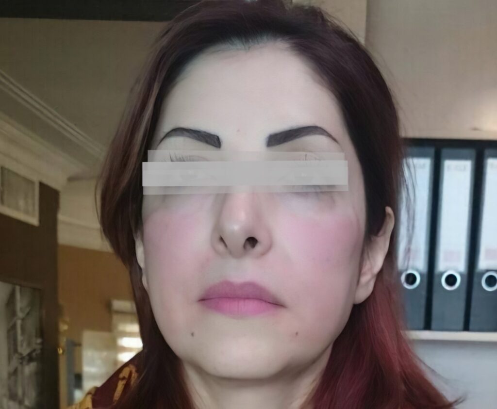 روش‌های نوین جوانسازی پوست بدون جراحی