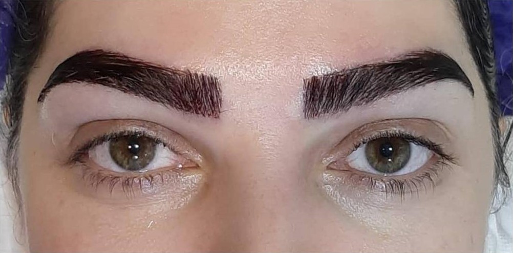 کاشت مو و ابرو برای بانوان