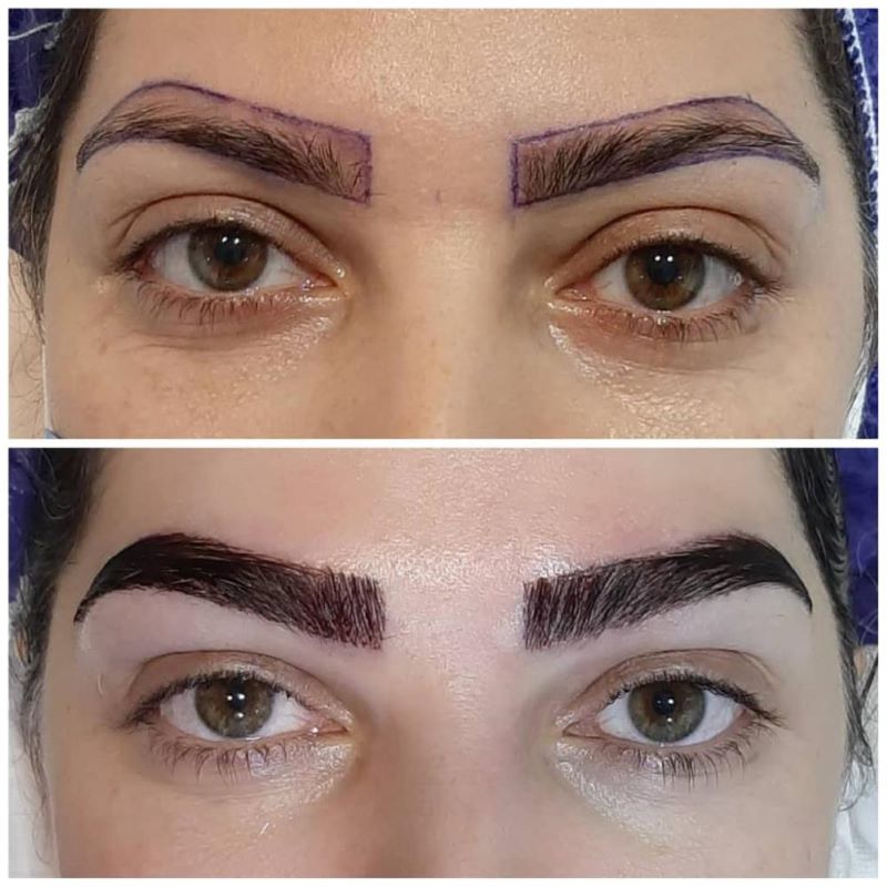 کاشت مو و ابرو برای بانوان کلینیک باران شهرک غرب تهران