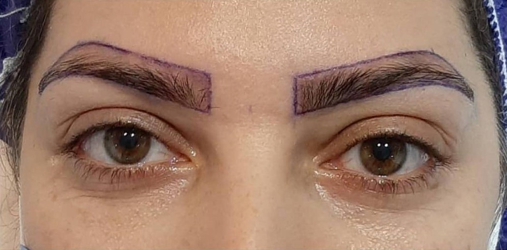 کاشت برای بانوان