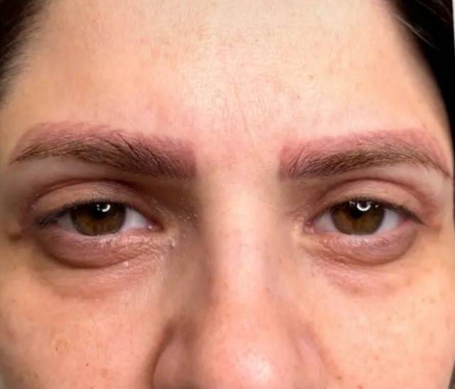 کاشت مو و ابرو