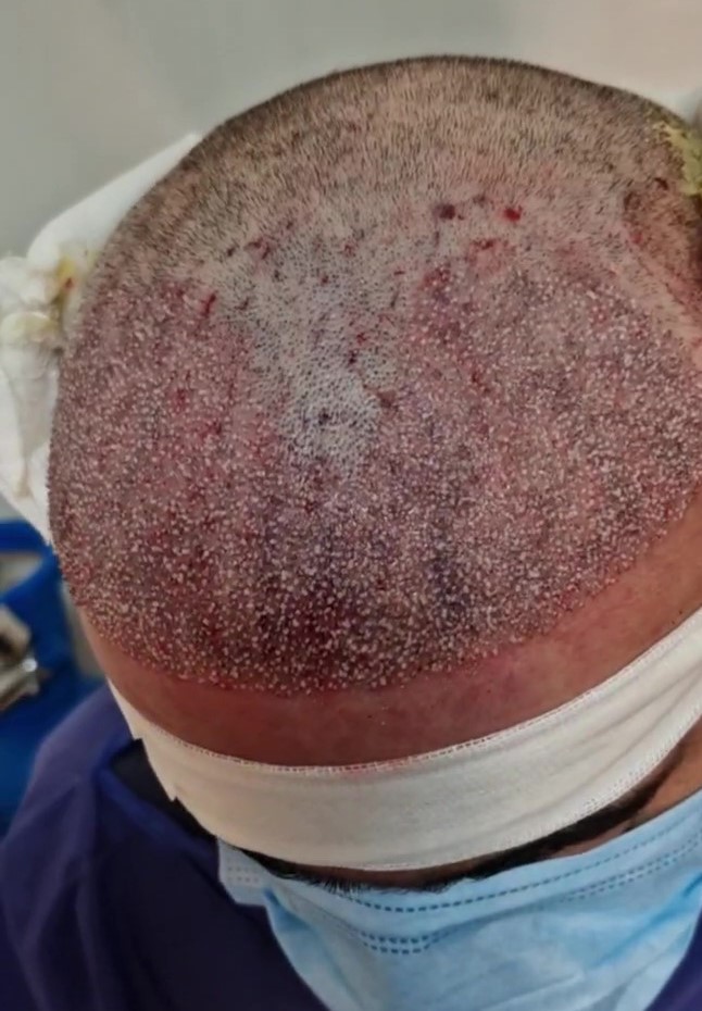 کاشت مو آقایان کلینیک باران شهرک غرب تهران